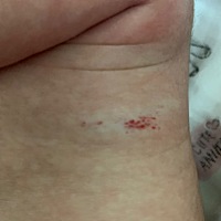 请问宝宝身上的红点是什么，查了网上说是草莓血管瘤，还没有去医院复查，一直很担心，会随着宝宝长大而...