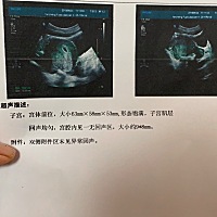 才怀孕第一次B超时候的形态 应该属于长形 大姨妈过了两天测出来两条杠 1.整个孕期没有反映、才开始想睡...