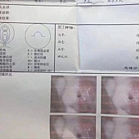 天天看你们发两条红杠，我太太太羡慕嫉妒了。因为生完大宝没有好好调理。不知道咋回事就有了宫颈糜烂和...