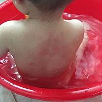 一块一块红的这是湿热了么？ 😥