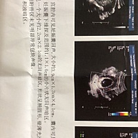 第一张是第一次做的B超，2.2×2.1～第二张是一个礼拜去做得B超～0.8cm吸收很多，很好👌🏻.现在六周...