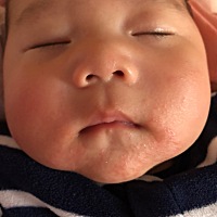 嘴巴有湿疹怎么办呀？不敢乱涂药，有经验的宝妈们给点意见怎么做，感谢！
