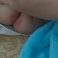 宝宝拉肚子已经四天了，PP都拉红了。怎么办