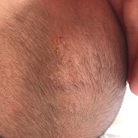 宝宝把头皮抓破了，肿了，怎么处理啊？