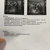 最开始是大硬块 发烧一礼拜 40度左右，因为疫情不敢出去怕被扣下，就在家忍着，找揉奶师通乳也没开，冷...