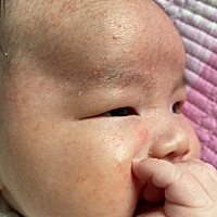 各位，我宝贝刚满月，脸上起的这是什么呀？怎么处理？刚开始少，现在越来越多了
