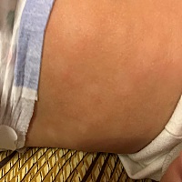 有次洗完澡以后搓了一下发现有这种情况 开始没有太理会 摸了一些油，后来又发现好几块 查了有的说的干性...