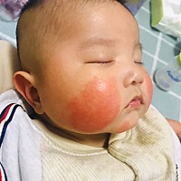 四个月的宝宝脸上湿疹特别严重，没有颗粒的那种，红红的，有什么好的办法吗？