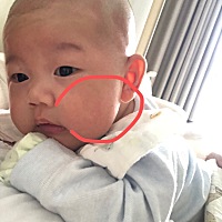 图一是宝宝一个月左右发现的，现在颜色还很浅的浅褐色不仔细看看不出来，仔细看就好像脸上脏了一块一样...