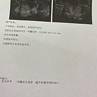 到底正常不正常  HCG167226.4 孕酮36.66