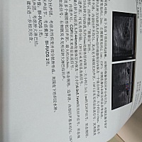 医生说这两天得不到疏通就得开刀切掉，目前状况荔枝大小，B超显示有一点点脓，现在住院打消炎针，自己热...