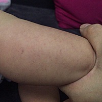 刚刚发现还没有去看医生，有没有哪位宝宝出现过这样的问题？