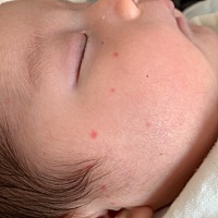 这红痘痘是怎么回事