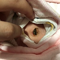 肚脐下面有点蹭破了，有点浓了有事吗？