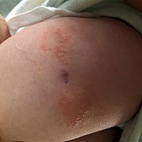 有没有人知道牛痘旁边起的是什么？需要去看医生吗？