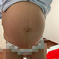 产前以为自己肚子没有妊娠纹，而且白白净净的，没想到产后还是逃不掉啊
