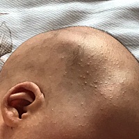 这种点点需要处理吗？今天去体检医生只说可能是湿疹，其他没有多说，我也没有多问。问问圈里宝妈们有这...