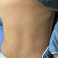 宝宝身上的这种干皮，是皮肤病啊还是皮肤干呀？腿上不这样，只有后背跟肚子这样