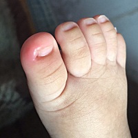 两个脚趾头都红肿了，看着都心疼