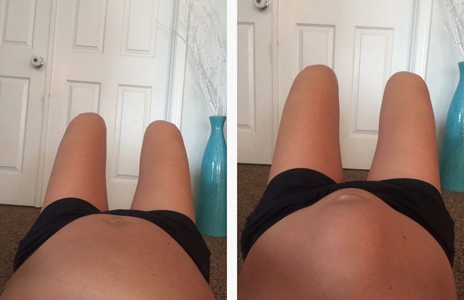 腹直肌分离对比图片