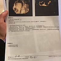 今天终于鼓起勇气做了四维超声造影，听说这个比传统碘油损伤要小，之前网上看都说很痛，紧张的不行，之...