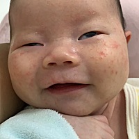 有没有宝妈知道脸上长的是什么东西？这是正常的吗？