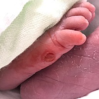 出生时右脚末脚趾下部皮肤有一块直径0.5厘米疮口。 疮口结巴后第三天洗澡粘水脱落后重新结巴。 不能愈合...