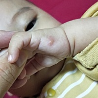 宝宝不知道被什么虫子叮咬了，宝妈们有什么擦了能消肿的药膏推荐？