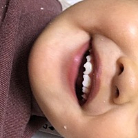 宝宝一岁多，两个门牙底部都缺一点，跟锯齿有点像，平时不怎么吃糖，怎么回事