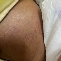 今天发现宝宝肚子两侧有这些花纹是怎么回事呀？