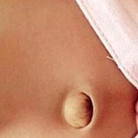 少数小宝宝，尤其是早产儿，生后不久会出现肚脐凸出，并有时大有时小，用手轻轻按压时，肿物缩小或者回...