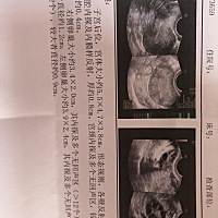 备孕一年 各种检查都做了 开始备孕就例假不正常了 三个月一次 喝了中药 两个月一次 又喝中药 医院去了几...