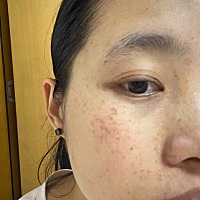 如果有快进键多好，哈哈哈。 祛斑药膏打卡第三天！ 雀斑是世上最顽固的斑了吧！ 加油！！