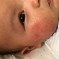 宝宝三个半月了，湿疹反反复复，宝妈们都用什么湿疹膏  好焦虑啊😓😓😓
