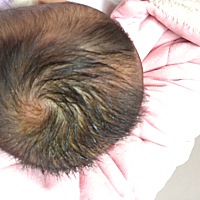 原来头上是疙瘩现在变成黄伽了，昨天去医院医生也没说是什么，就开了点药膏摸摸