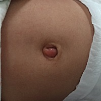 宝宝四个多月了，这几天肚脐总是红红的，湿湿的，我闻了一下还臭臭的，我用75％的消毒水清洗几次了不见...