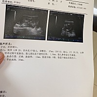 一胎是个小公主 二胎nt顺利通过 希望能儿女双全