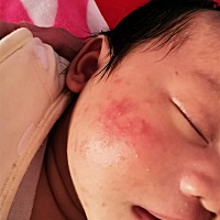 愁死了，都一个星期多了还没好，擦了药膏都不管用，怎么办？