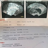 要了一年一直没动静，做检查有息肉，造影左侧输软管堵塞，医生建议要要看，可我心里没底，该不该做手术...