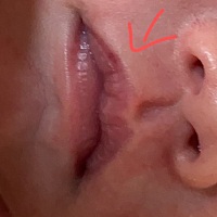 这个红色小印是什么啊？ 是血管瘤嘛 百度看都要吓死我了 月子做不好了