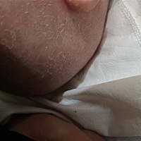 宝宝头是湿疹结痂，我用了橄榄油，停了几分钟。用清水洗成了这样，正常吗，好难过，宝宝头这样