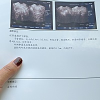 你没出现过盆腔积液吗？盆腔积液多少算正常？医生又吓唬我呢？保定的小伙伴们，千万不要去牡丹妇婴医院。