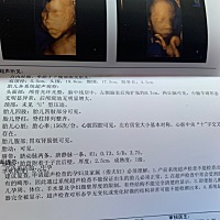 我现在五个半月，做四维发现左侧脑室扩张0.7  还贫血，让我忧心忡忡，孕期玻璃心太严重了，怕这怕。