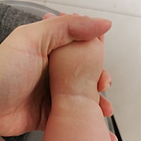 我家宝宝6个月了，最近在长牙。这几天她的皮肤出现了奇怪的现象碰一下红一块，像是蚊子包一样，但是过一...