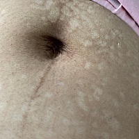 产后肚子上出现这样的白色点点，是妊娠纹么？