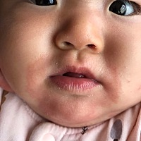 宝妈们，你们家有没有哪个宝贝像我宝贝一样的，长湿疹怎么办，放了好多种药都没用，求治愈办法，万分感激