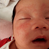 去医院给医生看了，医生给开了一个这个药膏，说擦擦就好了，今天使用是第三天了，怎么好像变严重了呢，...
