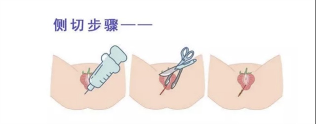 就这么看来，如果伤口撕裂只有一度或二度，那么撕裂会比侧切恢复的快，如果撕裂达到三四度，那么侧切的痛苦则会相对减少。
 
其实，准妈妈不必过度焦虑，生产时，医生会考虑当时生产的情况进行判断的，孕妈现在做的就是要保持好的心情，为产前做好准备。

02
怎样避免侧切和撕裂？
 
世界卫生组织有关调查显示，美国侧切率是23%，瑞典只有10%，而中国侧切率高达95%左右，远高于其他地区。

那么，有哪些方法可以降低侧切和撕裂的几率呢？