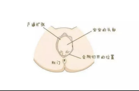 01
侧切和撕裂哪个更惨？
 
撕裂，就是孕妈在生宝宝的过程中，由于宝宝体积过大或孕妈用力不当，造成产道口被撑开，引起的会阴处撕裂。



撕裂的程度不同，伤口疼痛也不同：
 
一度撕裂：会阴部皮肤黏膜裂伤，影响较小；
 
二度撕裂：会阴皮肤、黏膜、肌肉裂伤，需要简单的缝合，恢复快；
 
三度撕裂：损伤皮下软组织，而且肛门、括约肌都会裂伤，需要及时处理和缝合。
 
四级撕裂：组织损伤严重，容易造成感染、尿失禁等不适应症状。