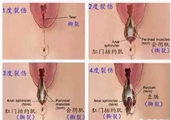 侧切，就是在可能撕裂的地方，通过手术切开，让胎儿的头部顺利通过。相比起撕裂，侧切的伤口更加平整。